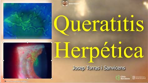 Queratitis Herpética YouTube