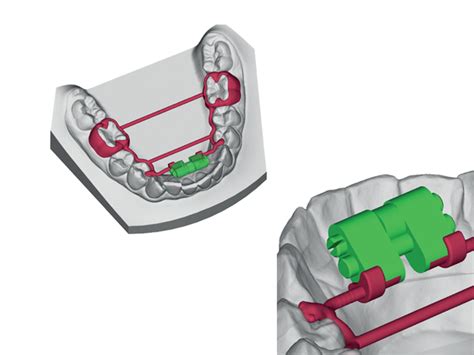 Cad Cam Unterkiefer Gne Schraube Torko Zahngetragen Orthoby