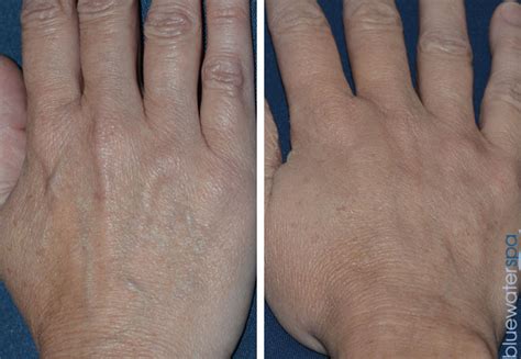 Hand Rejuvenation