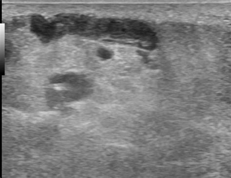 Superficial Thrombophlebitis Ultrasound