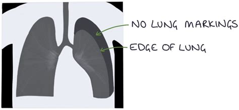 Pneumothorax Zero To Finals