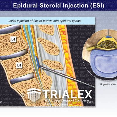 Epidural Steroid Injection Esi What It Is Benefits Off