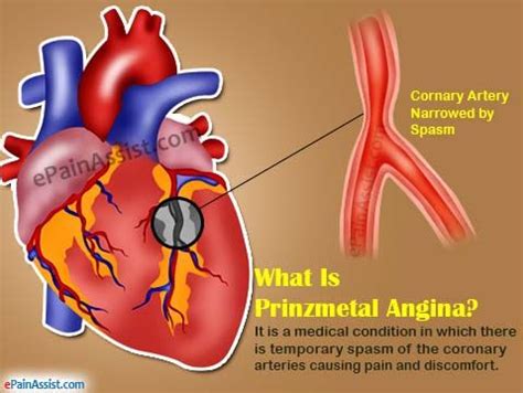 Angina Prinzmetala Przyczyny Objawy Leczenie D Awicy The Best Porn