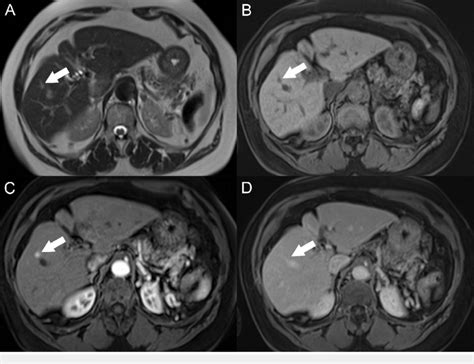 Liver Nodules On CT Scan