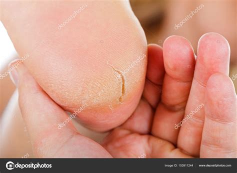 Talón humano seco agrietado de cerca fotografía de stock ocskaymark