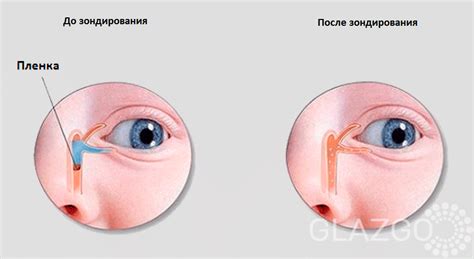 Дакриоцистит у новорожденных и взрослых – причины, симптомы, лечение ...