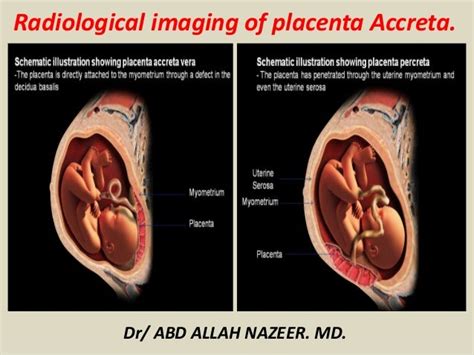 Presentation1 Radiological Imaging Of Placenta Accreta