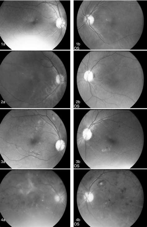 Diabetic Retinopathy Screening Programme Utilising Nonmydriatic Fundus