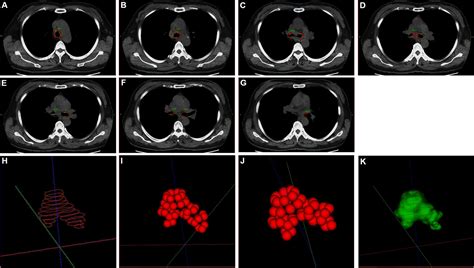 Frontiers Stent Loaded With Radioactive Iodine 125 Seeds For Adenoid