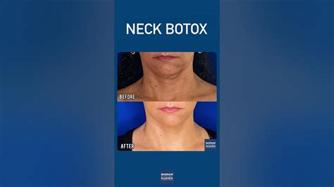 Neck Botox Smooths Out The Lines On The Neck By Injecting Into The Platysma Muscle Youtube