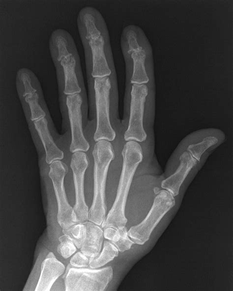 Normal Hand X Ray