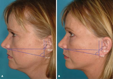 Figure 1 From Reducing The Incidence Of Ear Deformity In Facelift Semantic Scholar