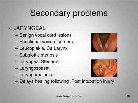 Lpr Laryngopharyngeal Reflux