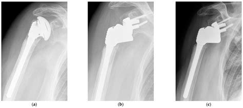 Jcm Free Full Text Conversion Of Hemiarthroplasty To Reverse