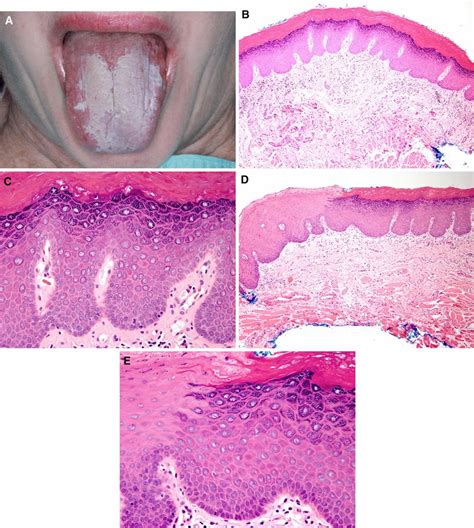 Leukoplakia Tongue Histology