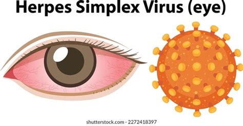 Herpes Simplex Virus Eye Illustration Stock Vector Royalty Free