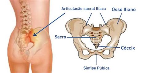 Dor Sacral Saiba O Que E O Que Ela Pode Causar Apostas