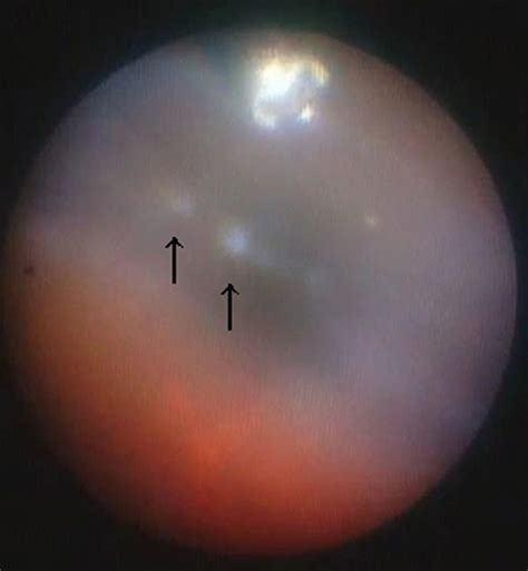 Intraoperative Endoscopic Findings With A 23 Gauge Cannula Inserted