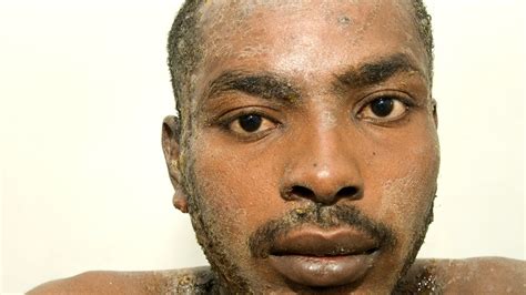 Psoriasis Nose