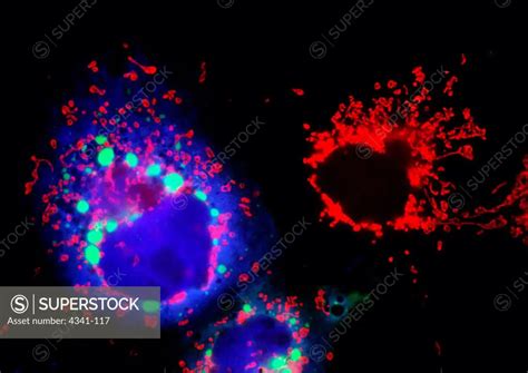 comparing mutant cell  normal cell microscopic view superstock