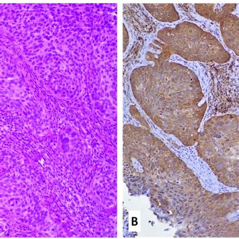 Fascin Expression In Cervical Cancer A B A Case Of Invasive Squamous