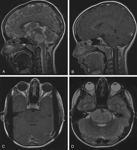 Brain Stem Tumor Mri