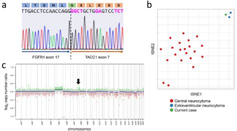 Sanger Sequencing Revealed The In Frame Fusion Of Fgfr Exon And