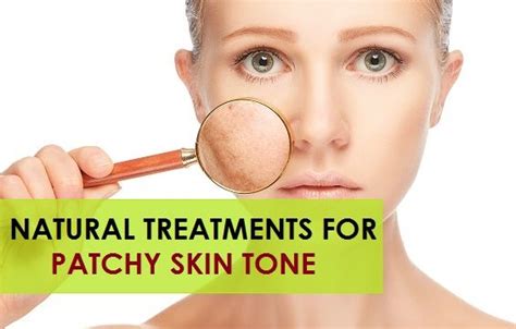 Best 8 Home Remedies To Remove Patchy Skin Tone and Dullness | Patchy ...