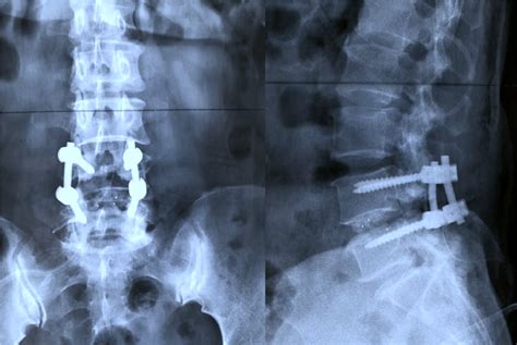 Spinal Fusion Rajiv Bajekal