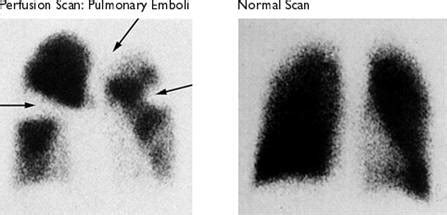 Lung Scan: St. Elizabeth's Medical Center | Steward Family Hospital ...