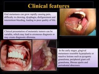 Metastatic Tumors Of Jaws PPT