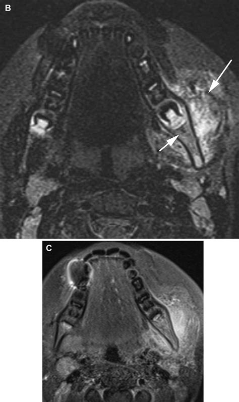 Pediatric Chronic Nonbacterial Osteomyelitis Of The Jaw Clinical Radiographic And