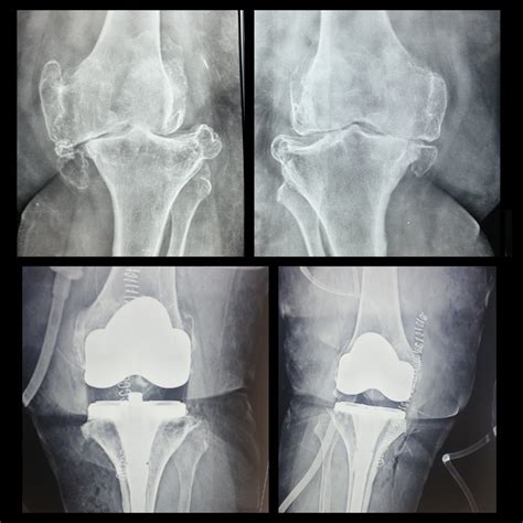 Single Stage Bilateral Total Knee Replacement Surgery Success Knee