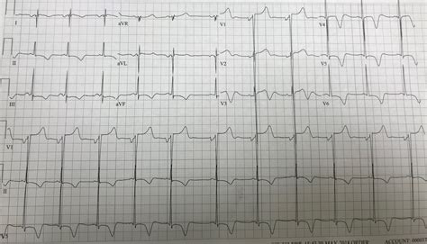 Cerebral T waves — The Pulse — Staten Island University Hospital ...