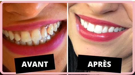 Comment Se Blanchir Les Dents La Maison Comme Les Youtubeuses