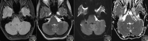 Radiology Mri Epidermoid Cyst Dwi