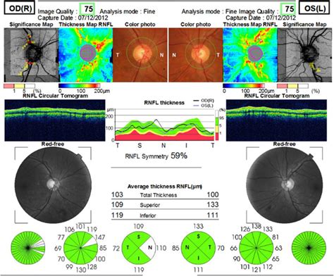 Typical Optical Coherence Tomography Oct Report Patient Number A