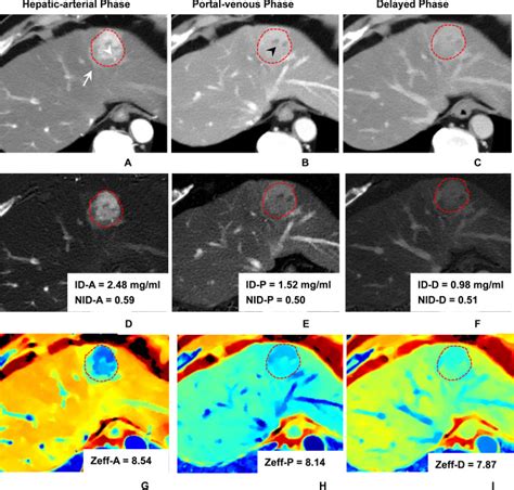 Prediction Of Microvascular Invasion In Solitary Afp Negative