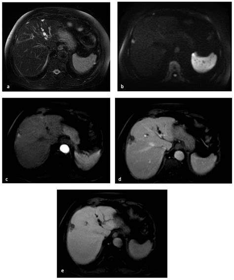 Diagnostics Free Full Text Imaging Diagnosis Of Hepatocellular Carcinoma A State Of The Art