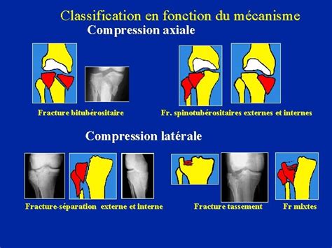 Les Traumatismes Osseux Du Genou Dr Belaid Service