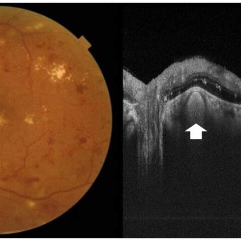 Post Operative Color Fundus Photo And Corresponding Oct Scan Of The