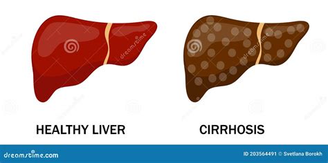 Ilustración De Hígado Sano Y Enfermo Cirrosis Arte Aislado Sobre