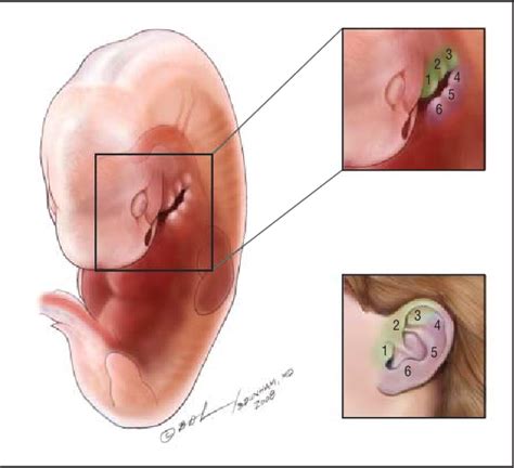 Congenital Preauricular Sinus Semantic Scholar