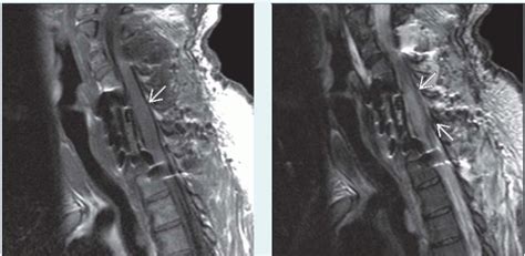 Spinal Cord Infarction Radiology Key Hot Sex Picture