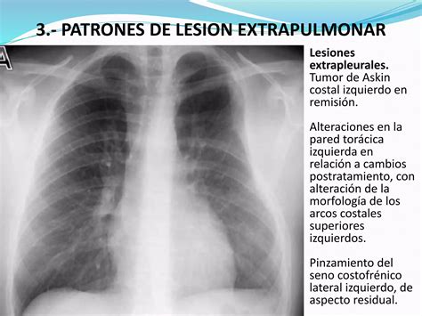 Principales Patrones Radiológicos En La Placa Simple De Tórax Ppt