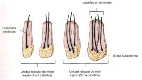 Presupuesto Para Implantes Capilares Unidades Foliculares Fol Culos