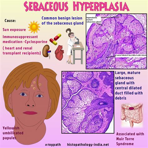 Sebaceous Hyperplasia | Pathology, Sebaceous gland, Human anatomy and ...