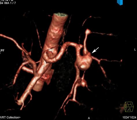 Radiodiagnosis - Imaging is Amazing-Interesting cases: Splenic Artery Aneurysm in Extrahepatic ...