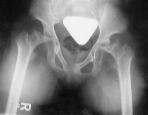 Preoperative Anteroposterior Ap Radiograph Of The Pelvis Showing