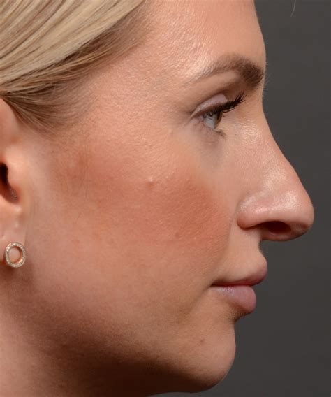 Rhinoplasty Before And After Case 461 Toronto Rhinoplasty Surgery